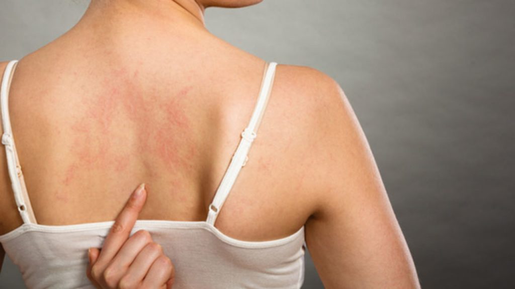 espalda de una mujer con vasculitis autoinmune